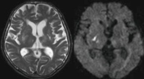 脳梗塞急性期のMRI画像