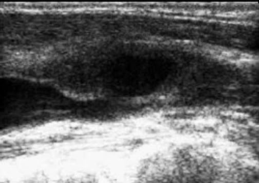頚動脈狭窄病変のエコー写真（縦断像）