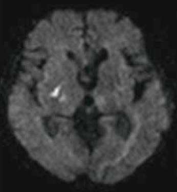 脳梗塞のMRI画像