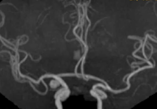 脳動脈瘤のMRA画像